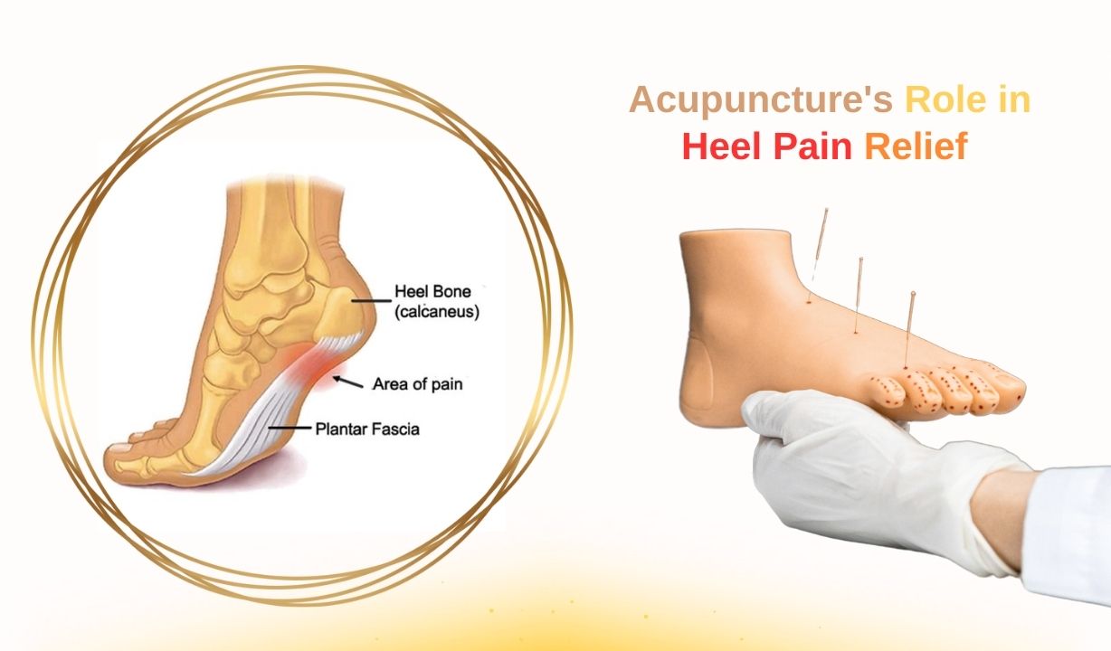 Infographic titled 'Acupuncture's Role in Heel Pain Relief' features two sections: 1) A gold-bordered anatomical diagram of a foot highlighting the 'Heel Bone (calcaneus),' 'Plantar Fascia,' and 'Area of Pain' (red shaded region). 2) A gloved hand holding a foot model with acupuncture needles inserted into the heel, illustrating targeted treatment points. The background transitions from white to yellow, emphasizing the therapeutic connection between anatomy and acupuncture therapy.