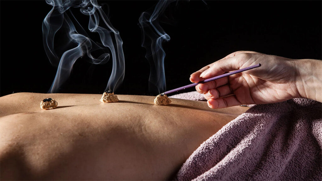 Naturopathic Remedies for IBS Relief 5 Remedies for IBS Relief: Moxibustion treatment on lower back with burning moxa cones, smoke rising, and purple towel; hand holds stick.